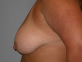 Patient # 92754 Before Photo # 5